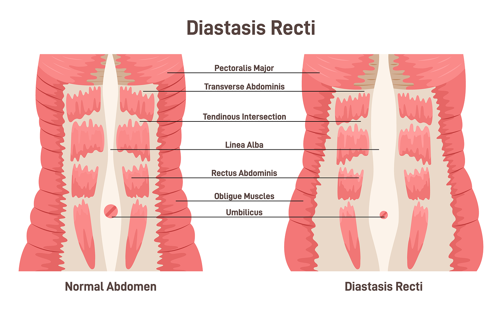 Diastasis Rect. Abdominal Muscles Separation. Human Torso Muscle