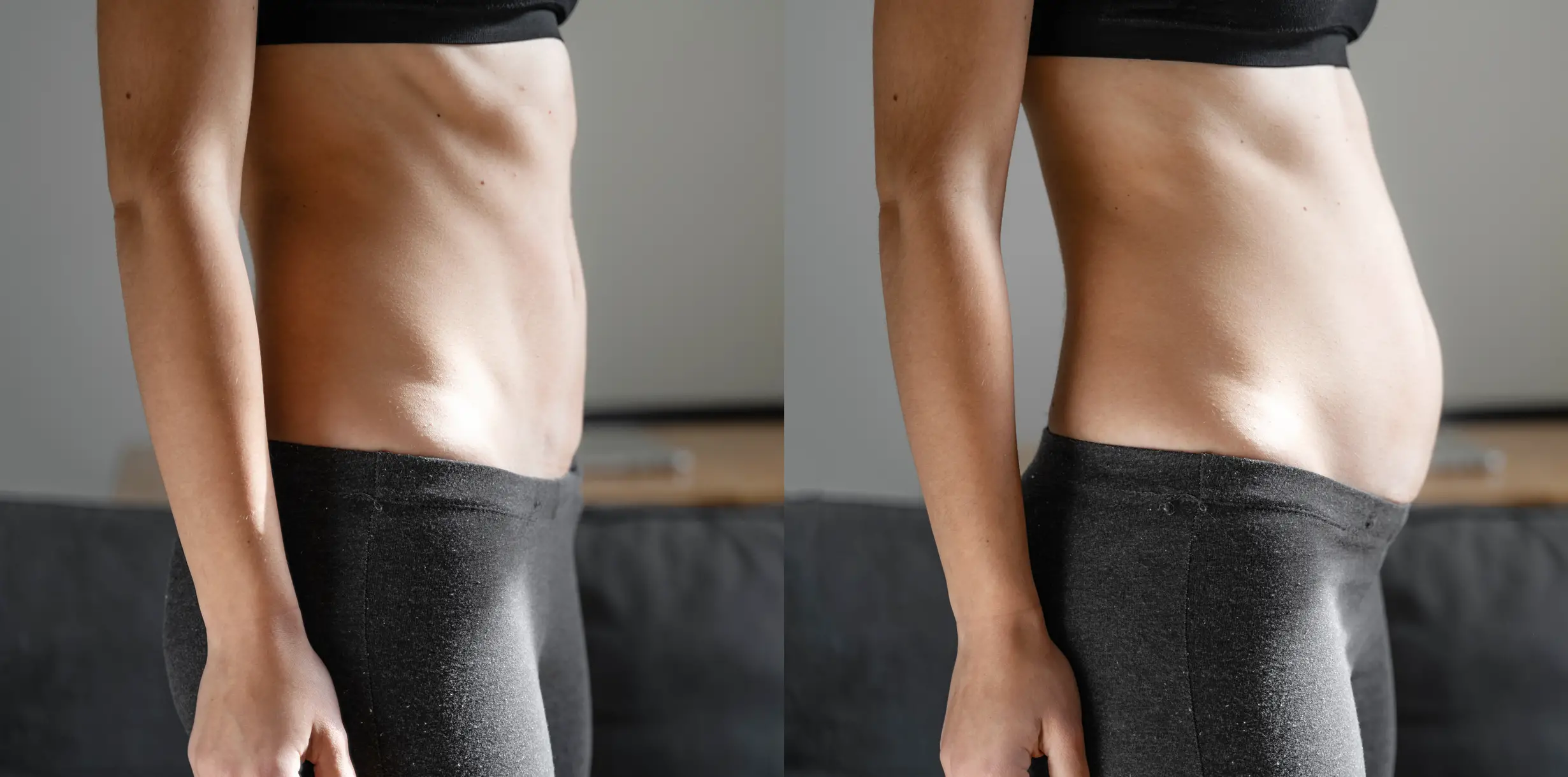 Before and after young woman side view of body showing Diastasis recti